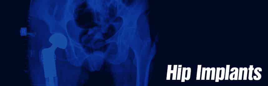 Hip Implant Injury Lawyer