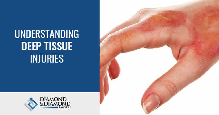 Understanding Deep Tissue Injuries