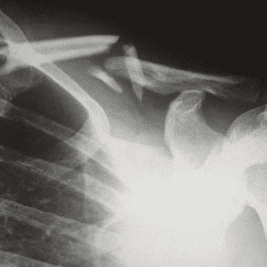 birth-injuries